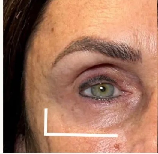 Before under-eye filler — hollowing beneath the eyes, before treatment at Sarah Aesthetics in New Hyde Park, NY
