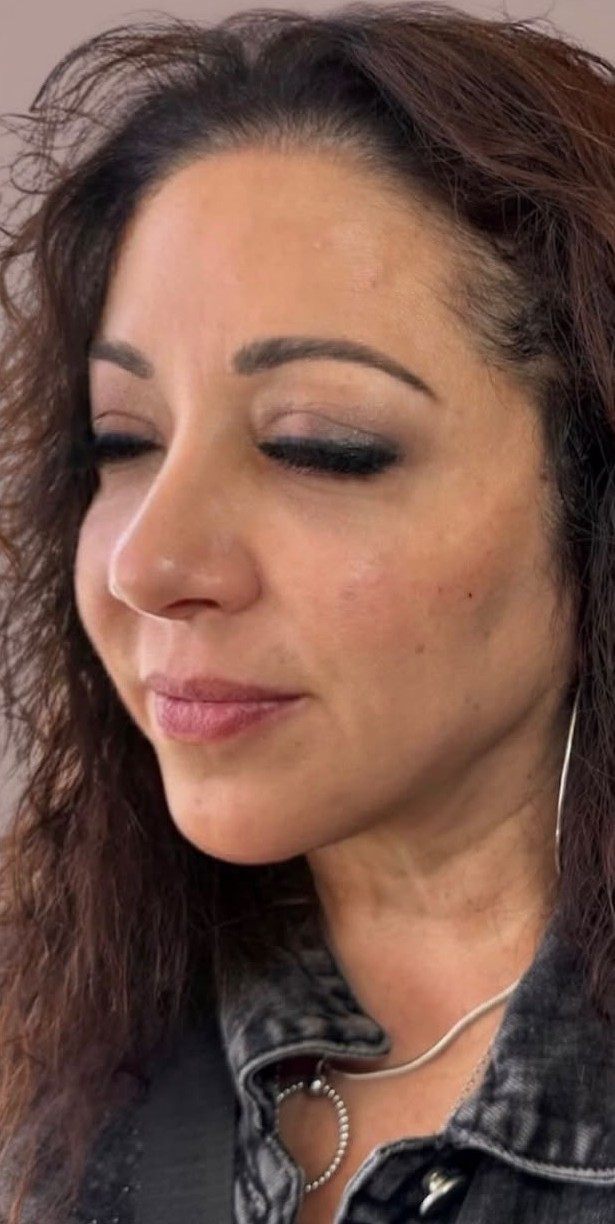 After full face rejuvenation — side profile following injectable treatment by Sarah Fuzailov, NP injector