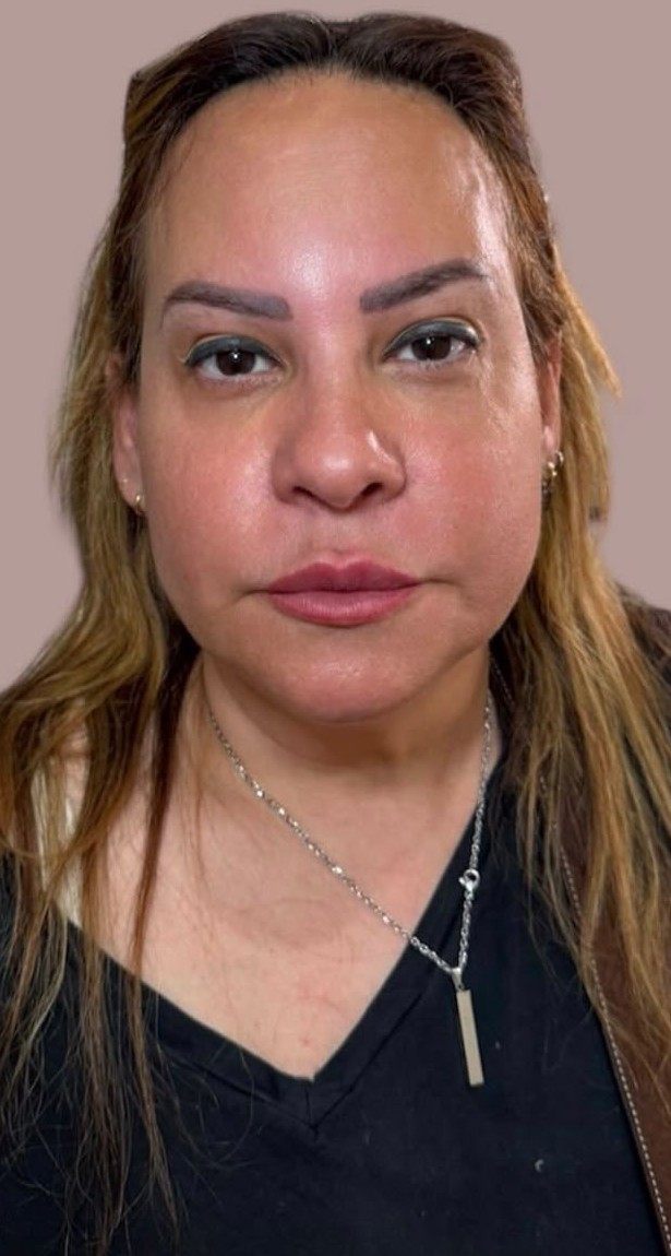 Before full face rejuvenation — front view prior to injectable treatment at Sarah Aesthetics, New Hyde Park, NY